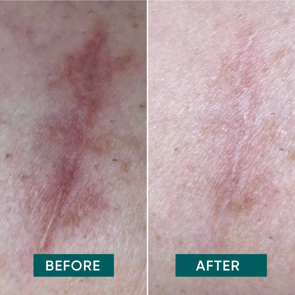 Arplaster med aloe vera | Genanvendelige silikonepads