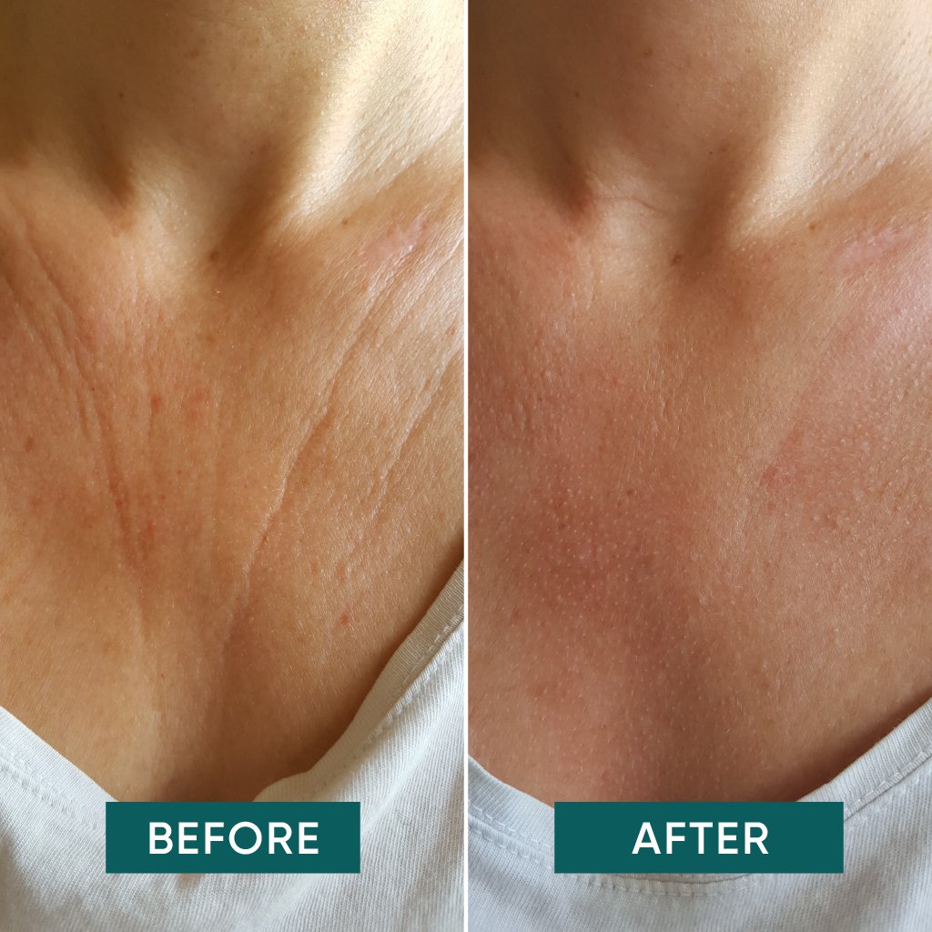 Genanvendelig silikonemaske til décolleté med C-vitamin effekt, hudpleje, anti-aging, bæredygtig skønhed