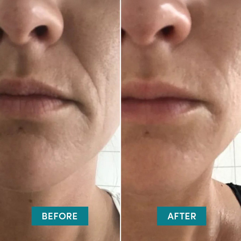 Silikonepads med hyaluronsyre | Genanvendelige Beauty Patches